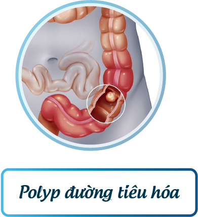 Viêm đại tràng, ruột kích thích